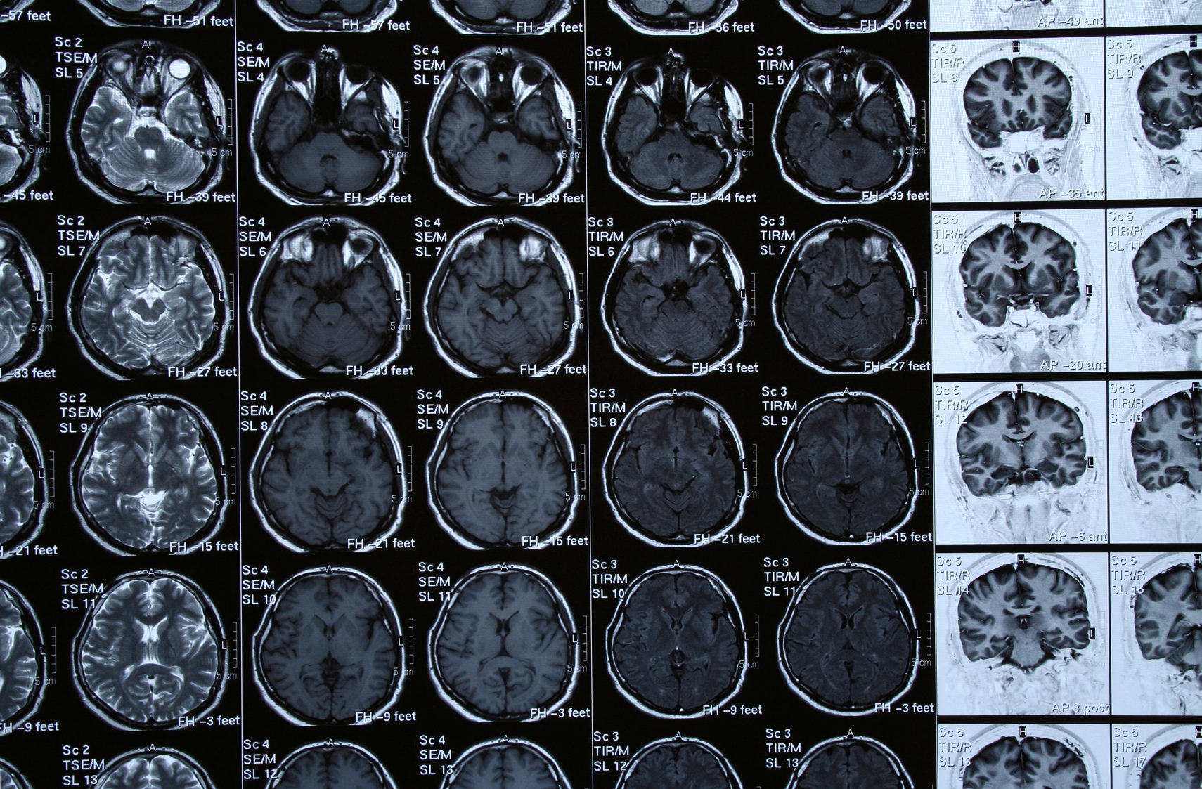 Ликворография головного мозга магнитно-резонансная