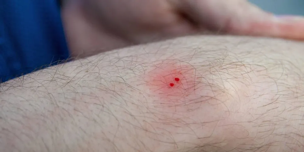 Human-environment-snake conflict snakebite