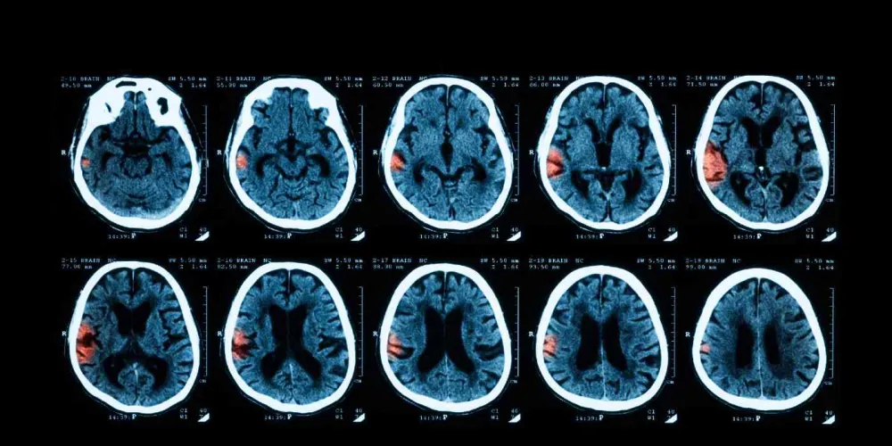 Intracerebral haemorrhage study